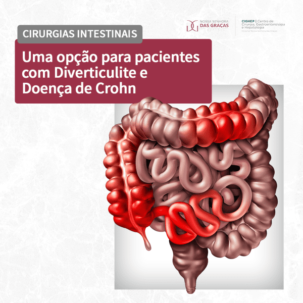 Cirurgias Intestinais Uma Opção Para Pacientes Com Diverticulite E Doença De Crohn Cighep 