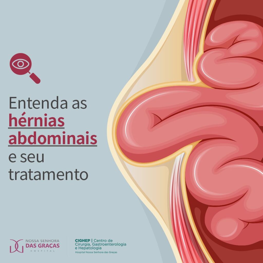 Entenda as hérnias abdominais e seu tratamento - Cighep