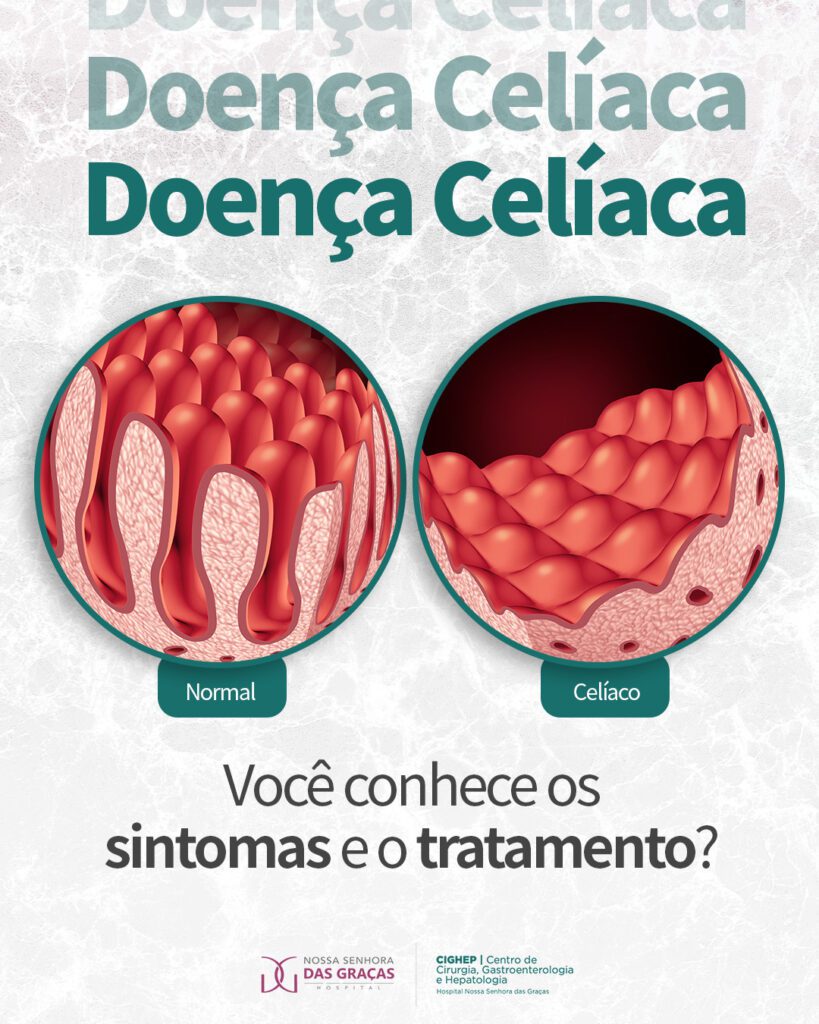 Doença Celíaca. Você conhece os sintomas e tratamento? - Cighep